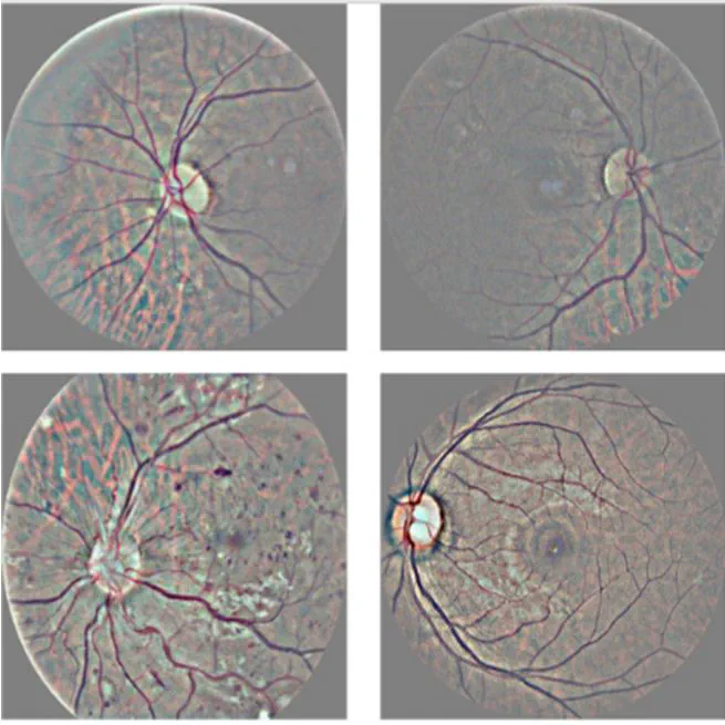 Detection of Diabetic Retinopathy Based on a Convolutional Neural Network Using Retinal Fundus Images